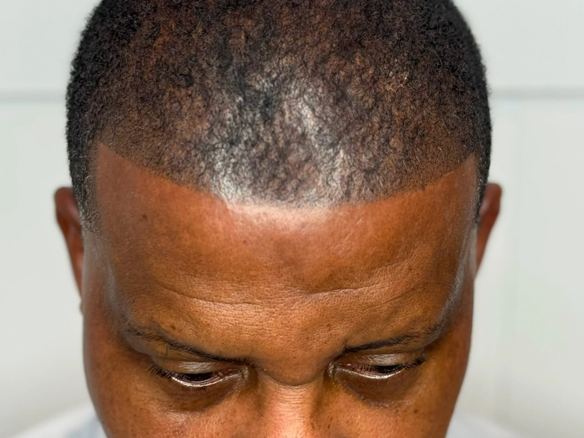 scalp-micropigmentation-west-hartford-ct-results-hairline-density-landscape-1